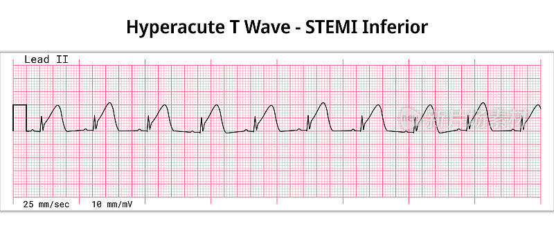 超急性STEMI - 8心电图第二张心电图纸- T波峰值